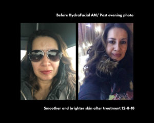 HydraFacial Skin Raleigh